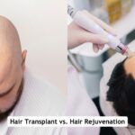 Hair Transplant