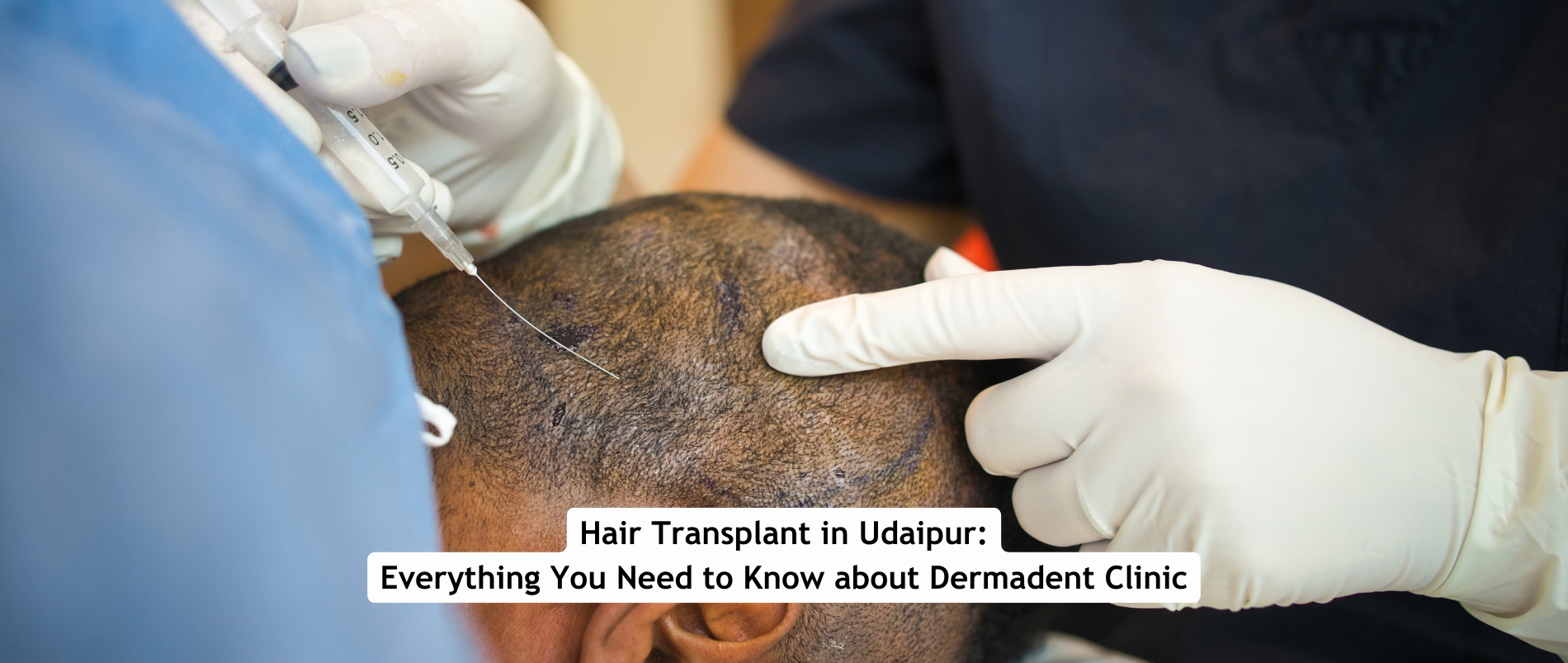 Hair Transplant in Udaipur