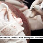 hair transplant in Udaipur