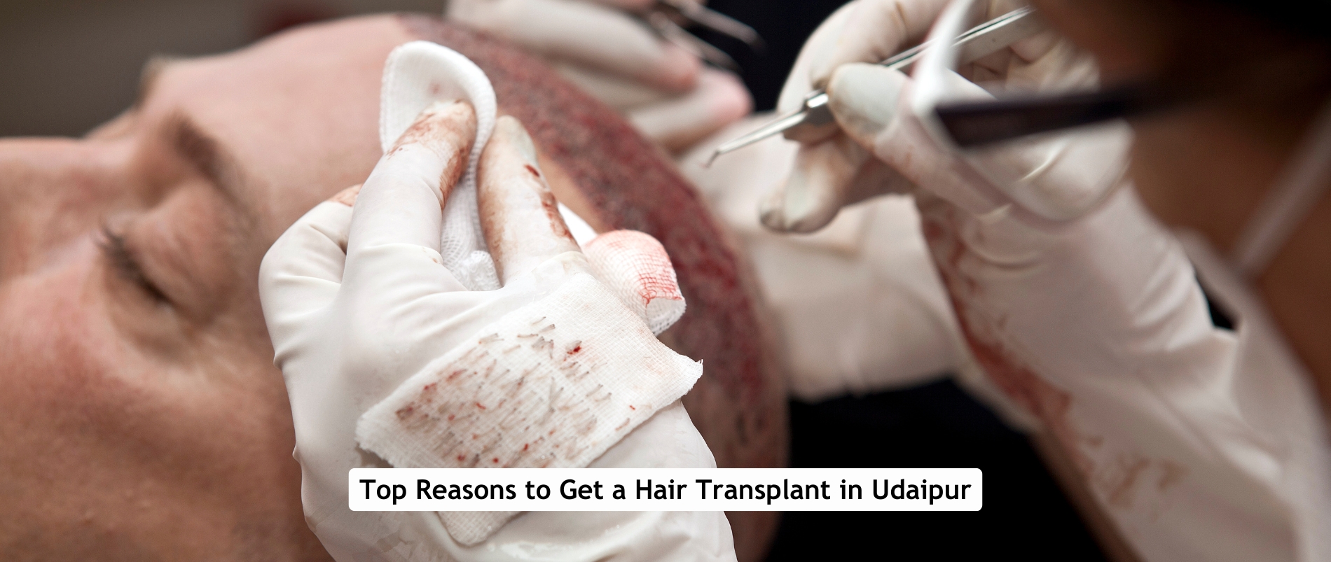 hair transplant in Udaipur