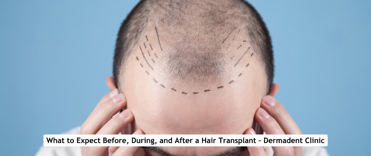 Hair Transplant in Udaipur